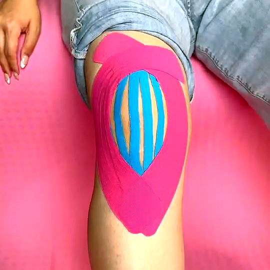 {"default":"Diagram illustrating the application of kinesiology tape for patellomalacia, featuring colored tape encircling the patella to provide support and mechanical correction."}
