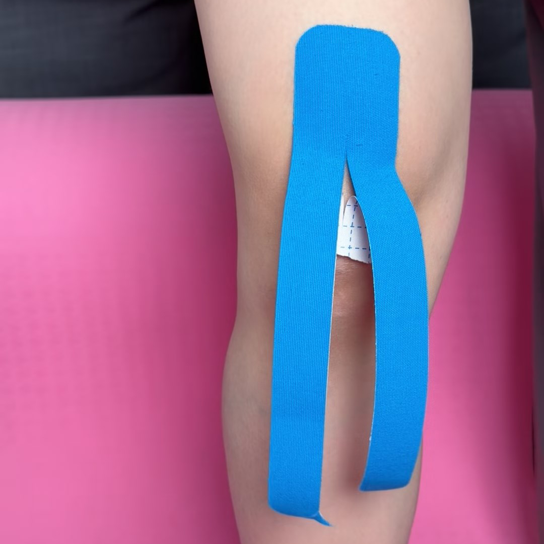 Y-strip anchor placed above the kneecap for jumper’s knee taping