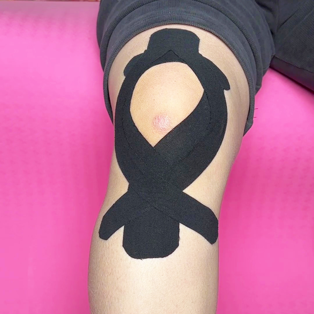 {"default":"muscle tape for Patellar Dislocation.jpg"}
